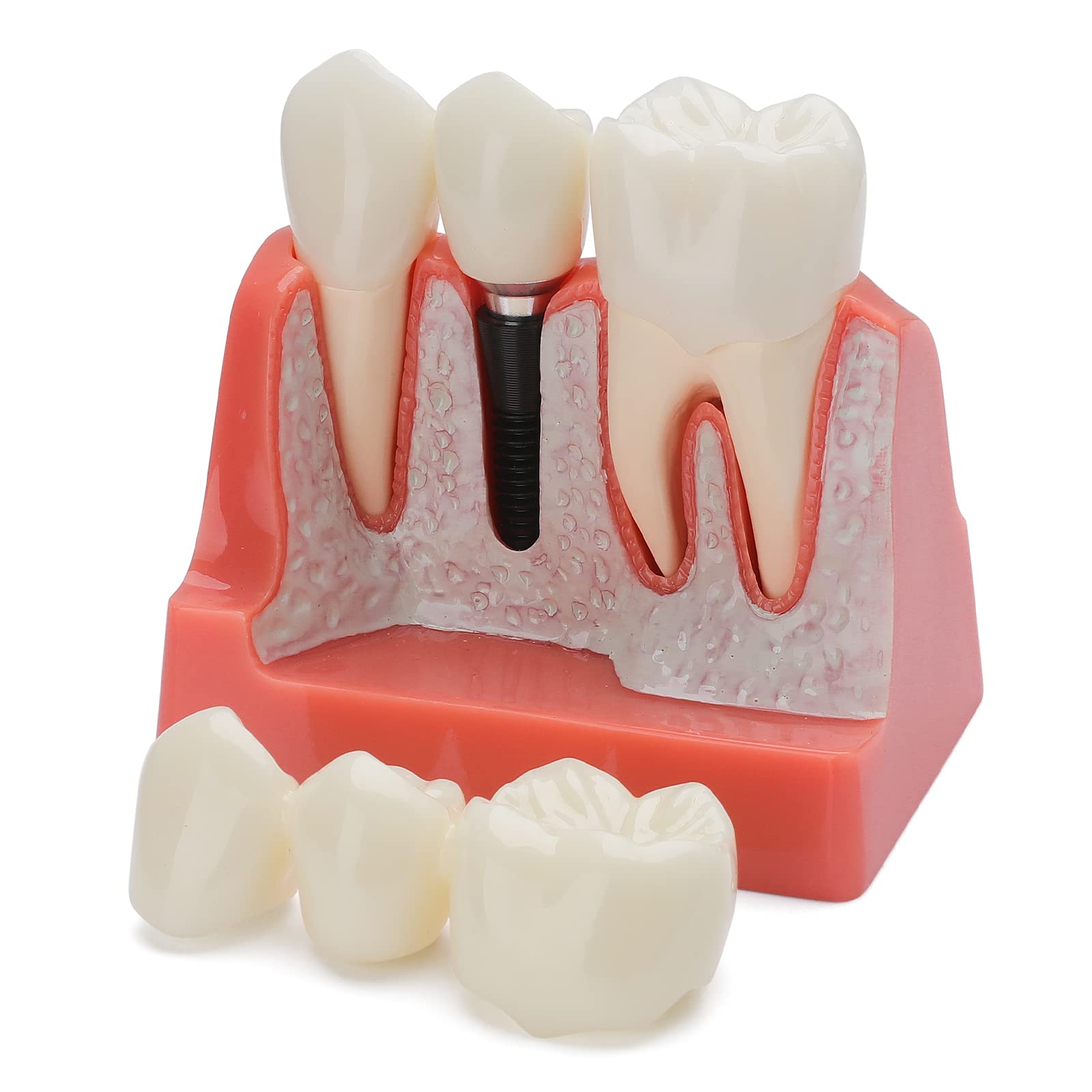 Dental Implant Model - 4X Removable Implant vs Bridge Demonstration Teeth for Dental Education & Practice | Perfect for Dental Students, Professionals & Training Clinics