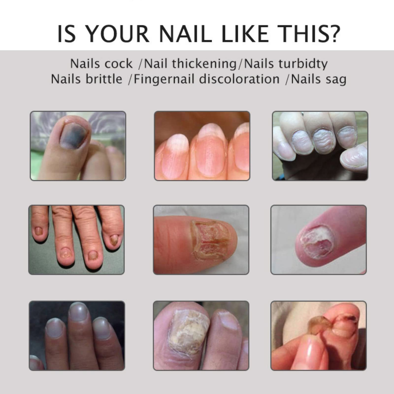 2PCS Nail Repair Gel for Fungal & Damaged Nails - Toenail Treatment & Care - Fast Results in 7 Days - Strengthens & Restores Nails - Perfect for Pedicures, Manicures & At-Home Nail Care