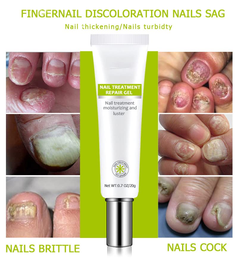 Efero Nail Treatment Repair Gel - Fungal Toenail Treatment, Nail Repair Cream for Yellow, Cracked & Split Nails - Renews Damaged Nails (4PCS) - Perfect for Home Pedicures & Nail Care Routines