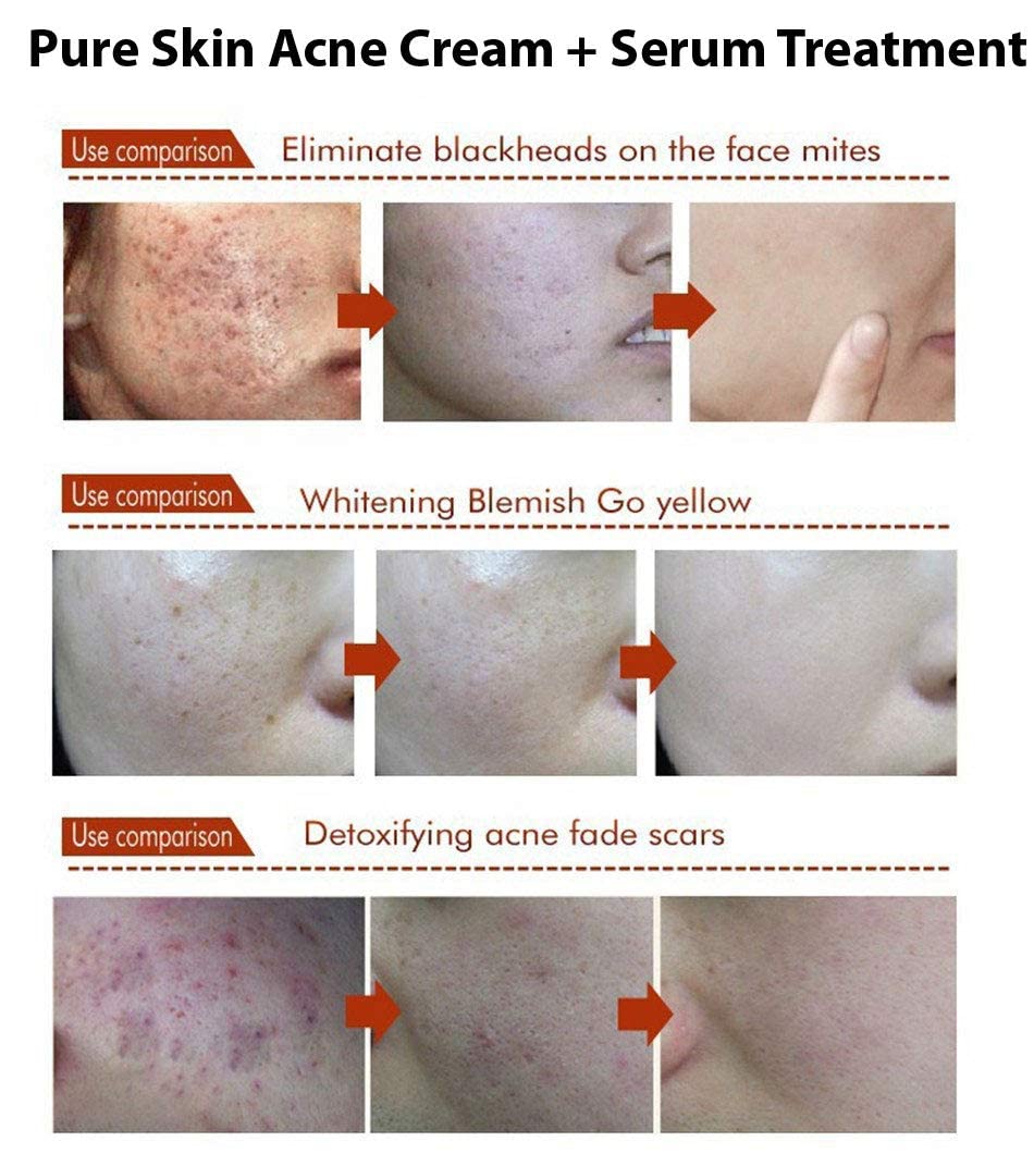 AquaBioaqua Acne Treatment Cream - Pimple & Scar Removal for Clear Skin | Face Care