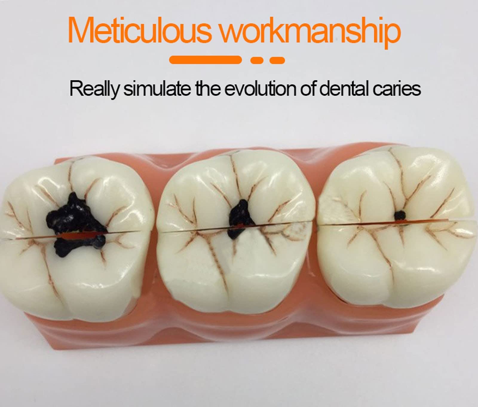 **Removable Dental Teeth Model - Caries & Tooth Decay Demonstration Kit for Dental Education, Teaching & Oral Health Training - Perfect for Dentists, Students & Classroom Learning**    *(Ideal for dental schools, clinics, patient education & hands-on training!)*