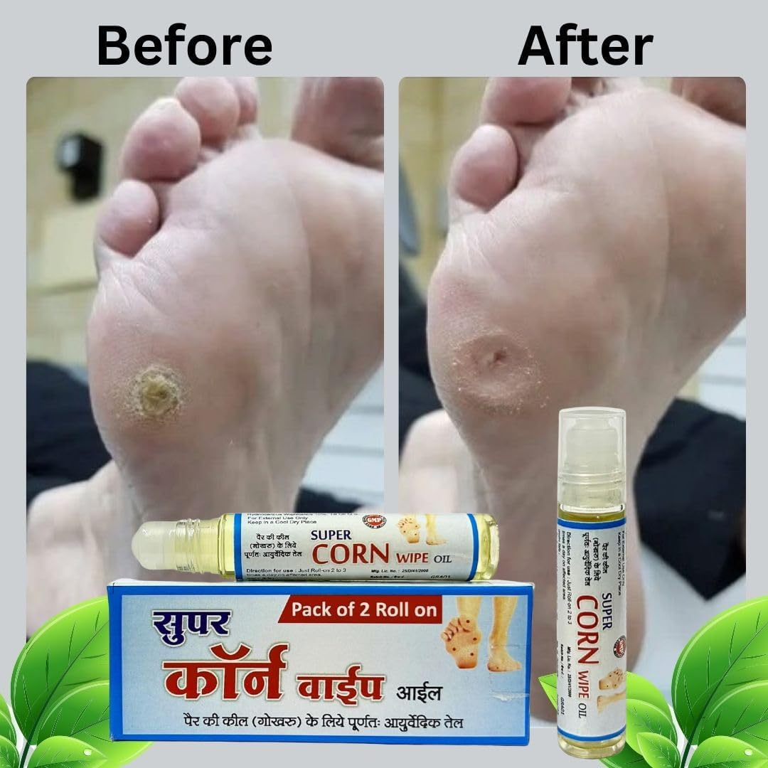 Super Corn Wash Callus Remover - 20ml Ayurvedic Foot Care Oil for Smooth Feet, Hard Skin & Plantar Wart Treatment | Natural Ingredients | Perfect for Pedicures, Cracked Heels & Dry Skin Relief