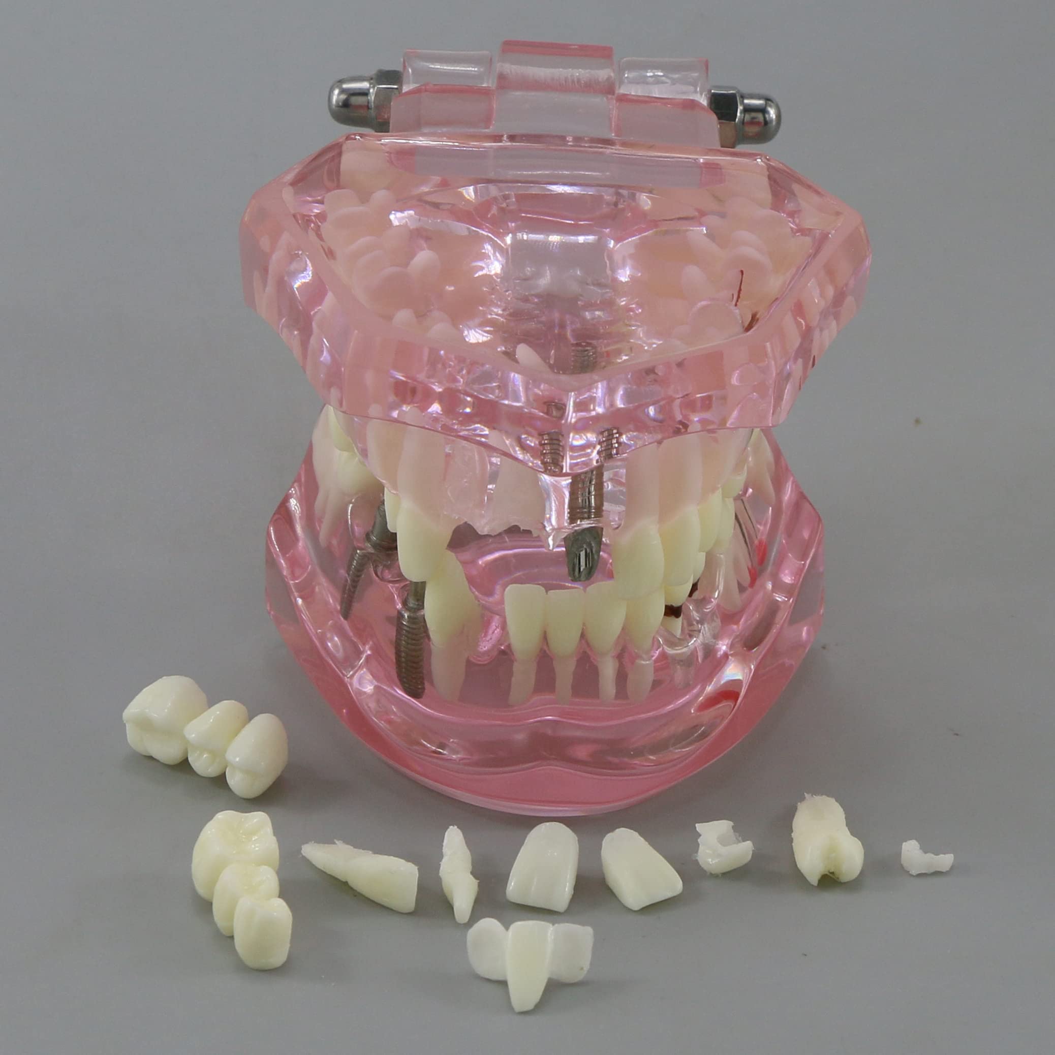 Dental Implant Typodont Model M2001 - Pink Oral Pathology Teeth for Dental Teaching, Study & Practice | Perfect for Dental Schools, Clinics & Training Demonstrations