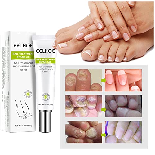 NHNX Nail Repair Gel for Fungus Treatment – Toenail & Under Nail Care Cream, Restores Discolored Nails (1.1x5.5 Inch, 1 Pack) – Perfect for At-Home Pedicures & Nail Health Maintenance