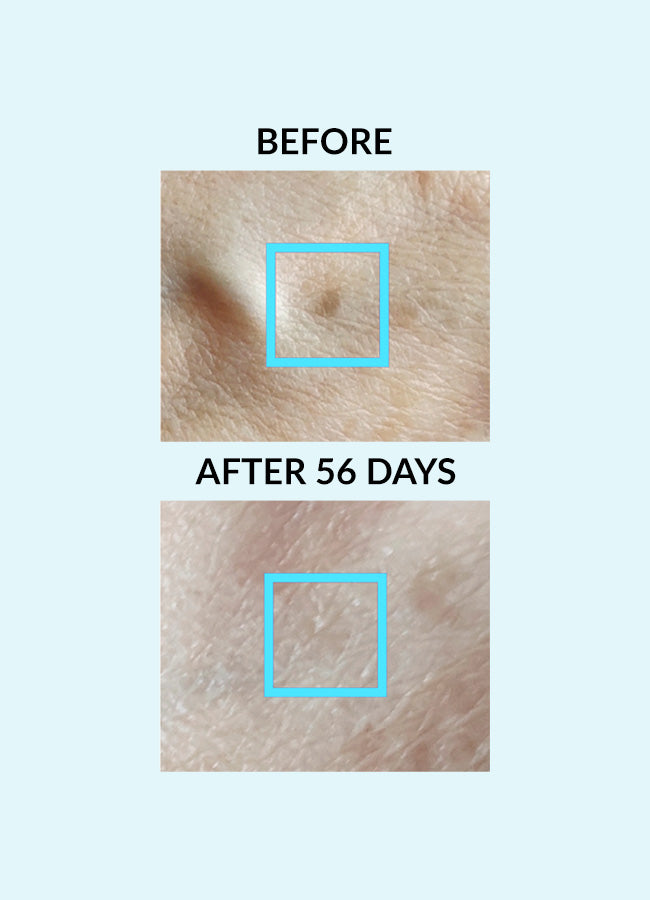 Best Pigment Control Patches for Age & Sun Spots - Brightening Dark Spot Treatment for Face & Body - Perfect for Daily Skincare Routine & Post-Sun Care