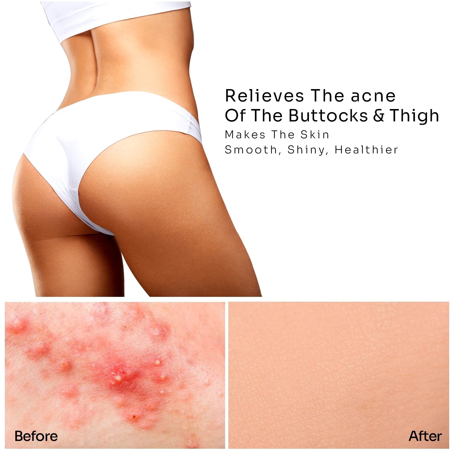 Dermlogic Anti-Acne Treatment for Thighs & Buttocks - Clear Breakouts & Prevent Blemishes - Perfect for Gym, Workout & Active Lifestyle
