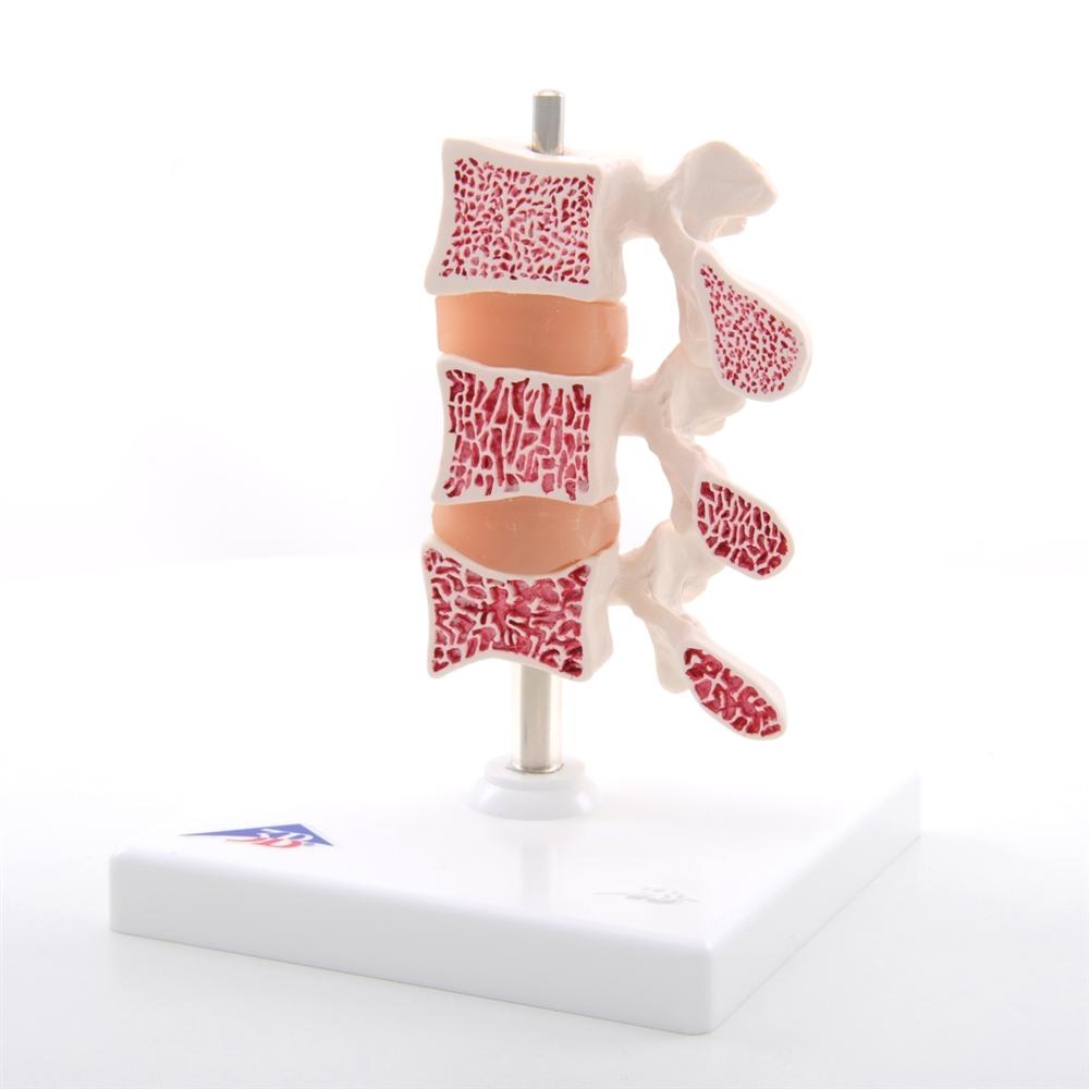 Premium Osteoporosis Bone Model - Anatomically Accurate Skeletal Display for Medical Education & Patient Demonstration - Perfect for Classrooms, Clinics, and Healthcare Training