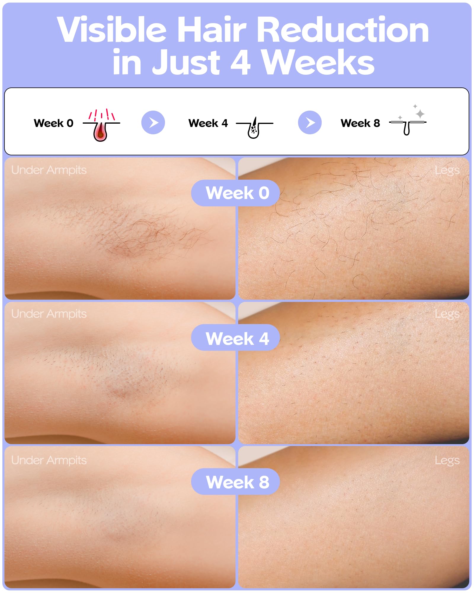 Ziska IPL Laser Hair Removal Device for Women & Men - Painless At-Home Hair Remover with Ice-Cooling System for Permanent Results - Perfect for Legs, Arms, Armpits & Bikini Line - Salon-Quality Hair Removal for Smooth Skin at Home
