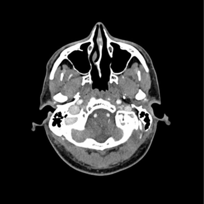 CTA AVM / Lesion Head Phantom - High-Quality CT Scan & X-Ray Training Tool for Medical Students & Radiology Professionals | Perfect for Diagnostic Imaging Practice & Medical Education
