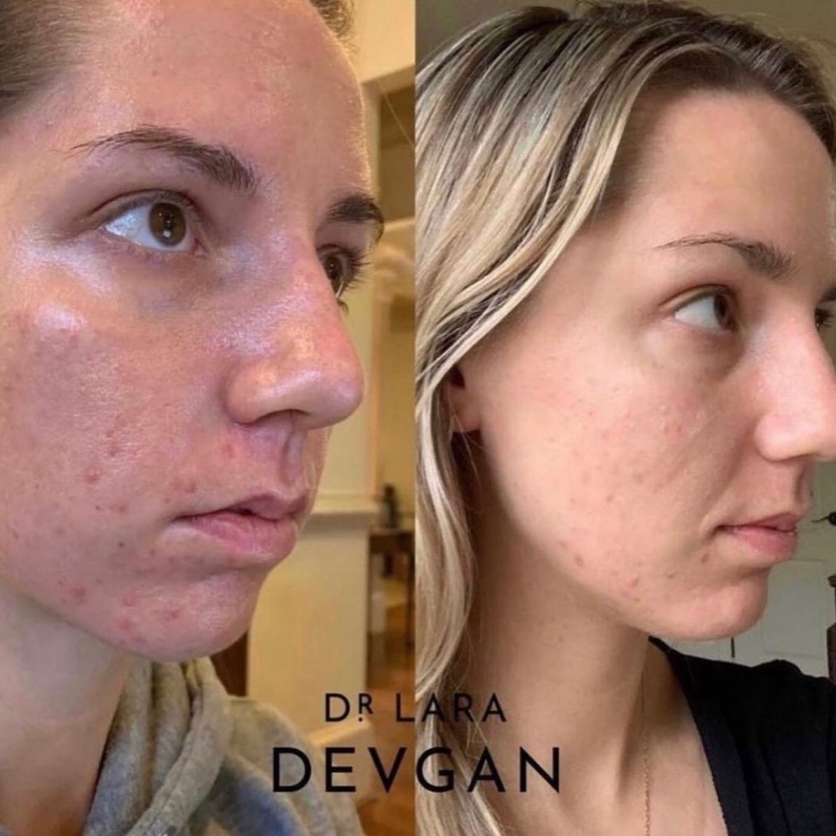 Dr. Devgan Vitamin C + B + E Ferulic Acid Serum for Face - Brightening, Anti-Aging & Hydrating Skincare Treatment - Perfect for Morning Routine & Sun Protection