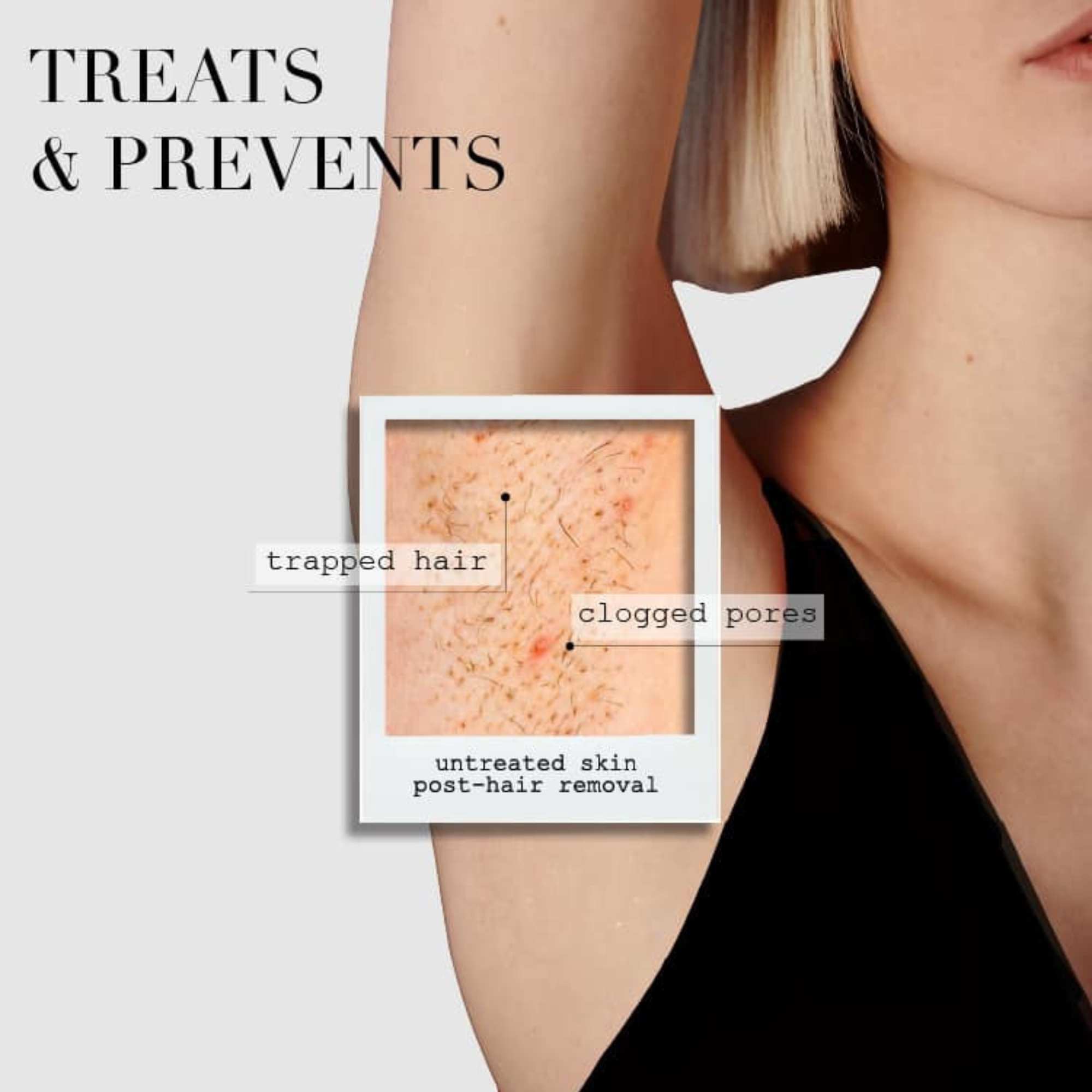 Takesumi Bright Ingrown Hair Treatment Bar - Natural Exfoliating Soap for Ingrown Hairs & Razor Bumps - Perfect for Post-Shave Care & Sensitive Skin (For Men & Women)