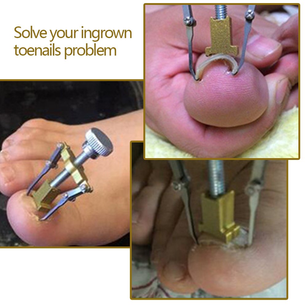 Ingrown Toenail Corrector Tool - Professional Toenail Treatment & Pedicure Kit for Pain Relief & Nail Care - Perfect for Home Use & Salon Treatments