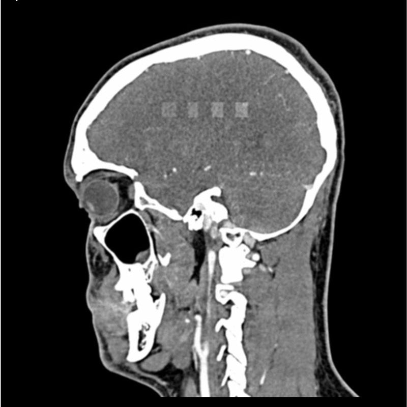CTA AVM / Lesion Head and Neck Phantom for CT Scan & X-Ray Training - Medical Imaging Practice, Radiology Education, and Diagnostic Procedure Simulation