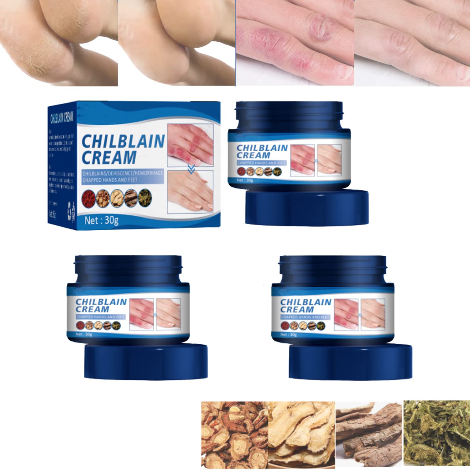 Chilblain Cream for Cracked Skin Repair - Anti-Cracking Frostbite Moisturizer with Deep Nourishing Formula - Foot & Hand Cream for Dry Cracked Heels - 3PC Set - Perfect for Winter Skin Care & Extreme Cold Weather Protection