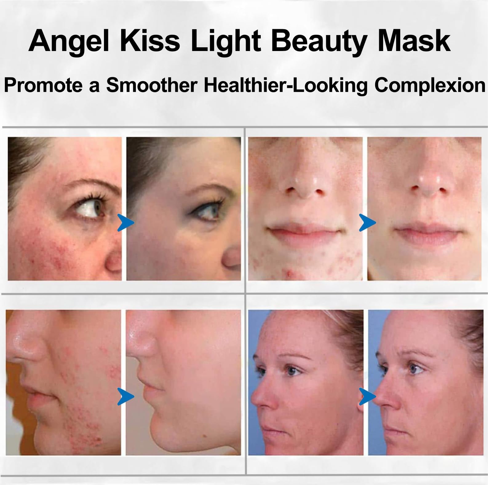 Angel Kiss LED Light Therapy Face Mask - Red & Blue Light for Anti-Aging & Acne Treatment - Professional Skin Care Device for Wrinkles & Dark Spots - Perfect for Home Spa & Dermatologist Recommended Skincare Routine