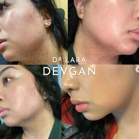 Dr. Devgan Advanced Lauric Acid Facial Cleanser - Gentle Foaming Face Wash for Acne-Prone & Sensitive Skin | Perfect for Morning & Night Skincare Routine