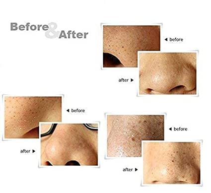 ADBHUTANAND Stainless Steel Blackhead & Acne Remover Tool - Pimple Extractor, Blemish Needle & Pore Cleaner for Face Skin Care | Perfect for Home Spa & Professional Skincare Routines