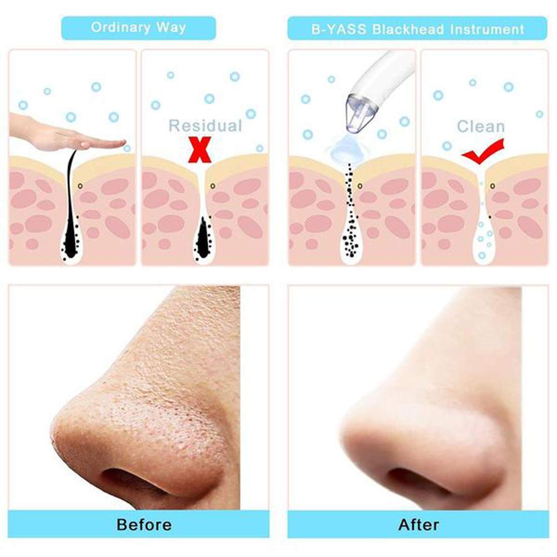 Exesoon Electric Facial Pore Cleanser & Blackhead Remover - Professional Vacuum Suction Skincare Device for Women | Microdermabrasion Machine for Acne, Pimples & Smooth Skin | Perfect for Daily Beauty Routine & Spa Treatments