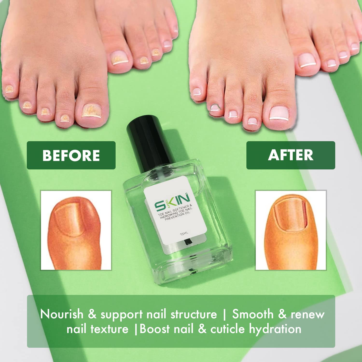 SKINAPEEL Ingrown Toenail Treatment Kit - Toe Nail Softener, Correction Oil & Clamp Tool for Pain Relief | At-Home Pedicure & Foot Care Solution