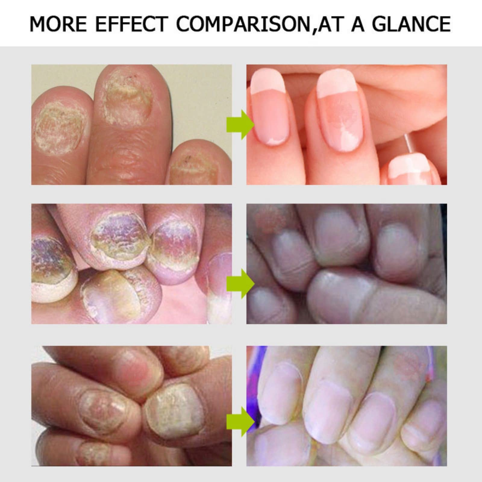 2PCS Nail Repair Gel for Fungal & Damaged Nails - Toenail Treatment & Care - Fast Results in 7 Days - Strengthens & Restores Nails - Perfect for Pedicures, Manicures & At-Home Nail Care