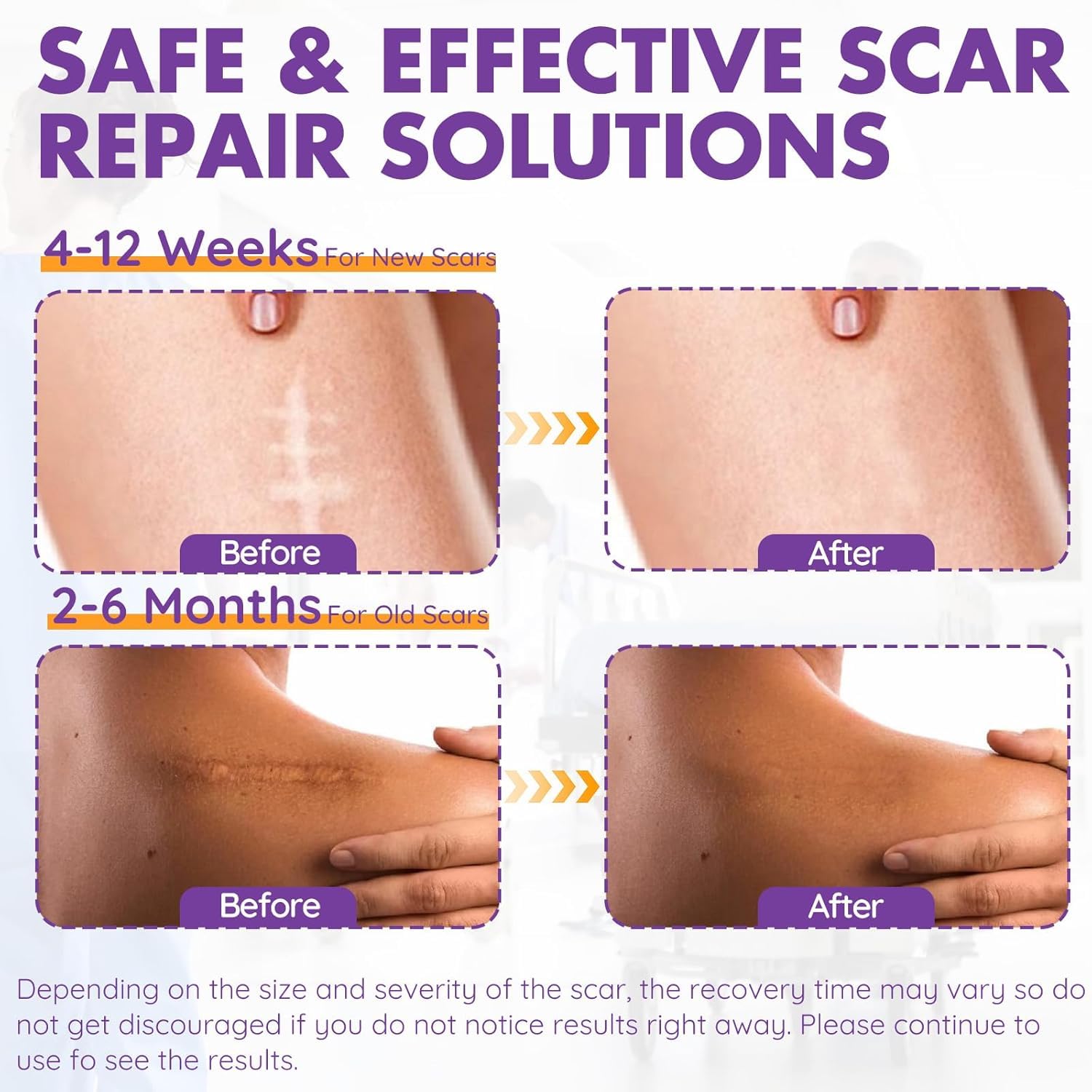 Professional Reusable Silicone Scar Sheets & Tape (1.6