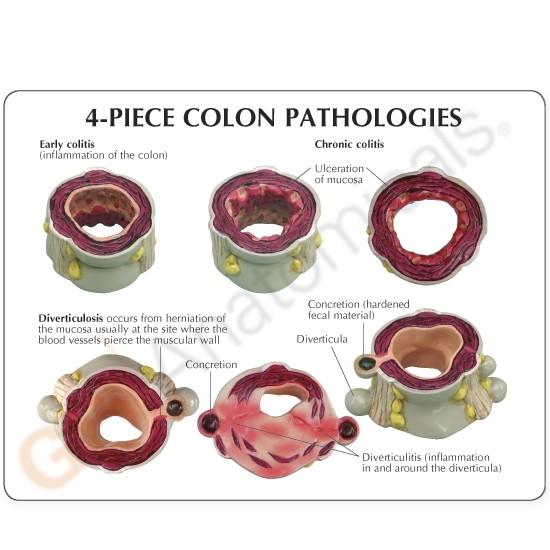 4-Piece Colon Anatomy Model with Pathologies - Ideal for Medical Students, Doctors & Healthcare Professionals