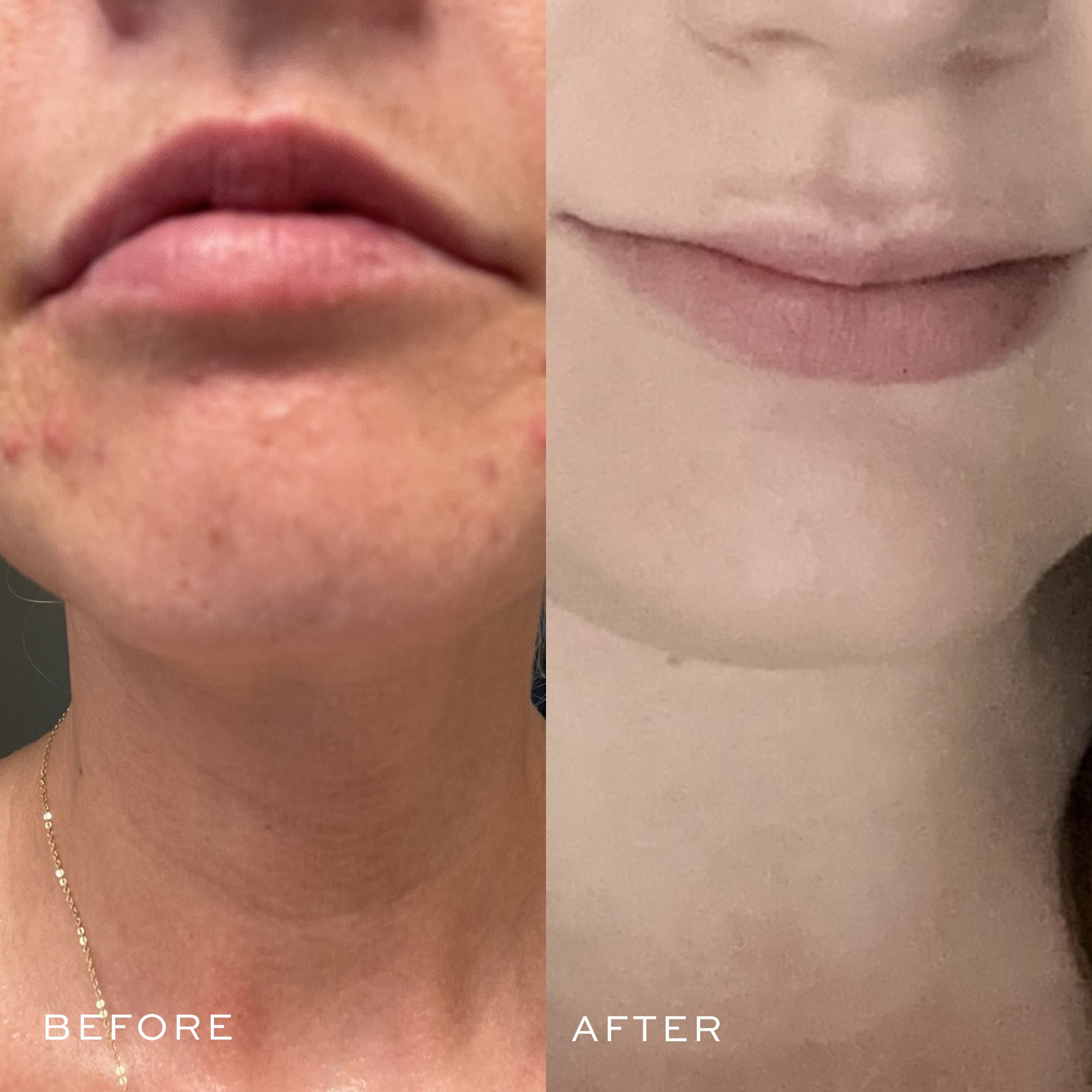 Best Acne Toning Serum for Clear Skin - Anti-Blemish Facial Treatment for Oily & Sensitive Skin - Perfect for Daily Skincare Routine & Post-Workout Care