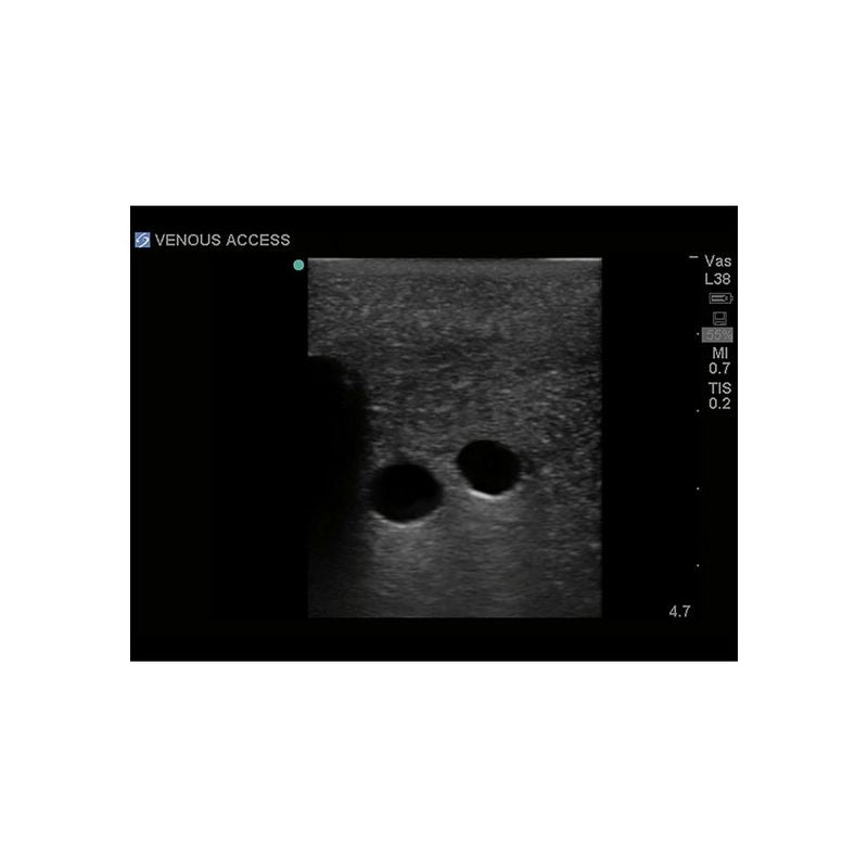 Gen II Central Line and Regional Anesthesia Replacement Insert - Sterile Medical Catheter for IV Therapy & Pain Management in Hospitals & Clinics