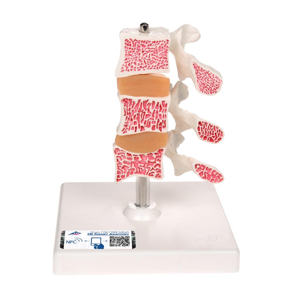 Premium Osteoporosis Bone Model - Anatomically Accurate Skeletal Display for Medical Education & Patient Demonstration - Perfect for Classrooms, Clinics, and Healthcare Training