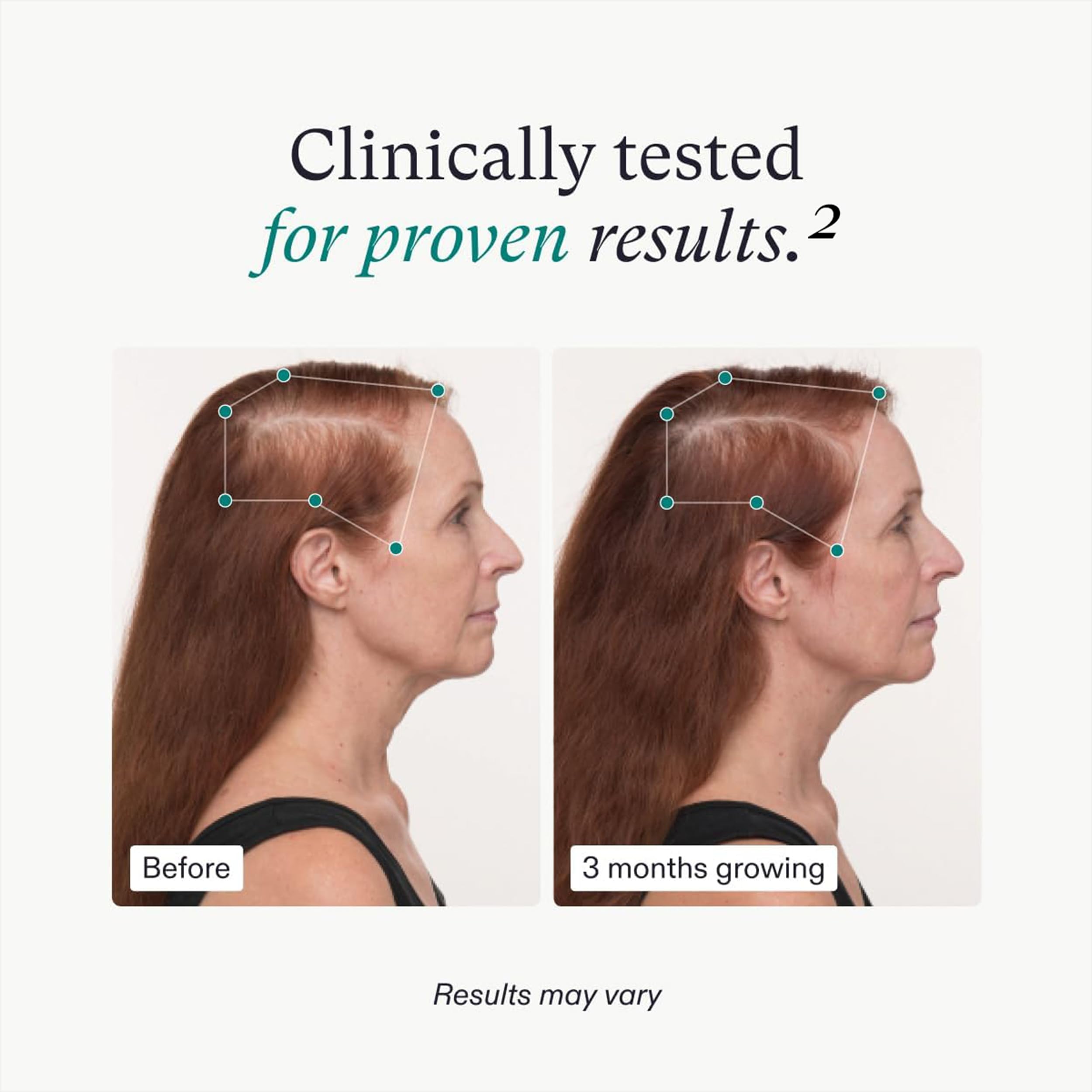 Nutrafol Women's Balance Hair Growth Supplements for Women 45+ | Clinically Proven to Support Thicker Hair & Scalp Coverage | Dermatologist Recommended Hair Vitamin | 1 Month Supply | Perfect for Menopause & Age-Related Hair Thinning