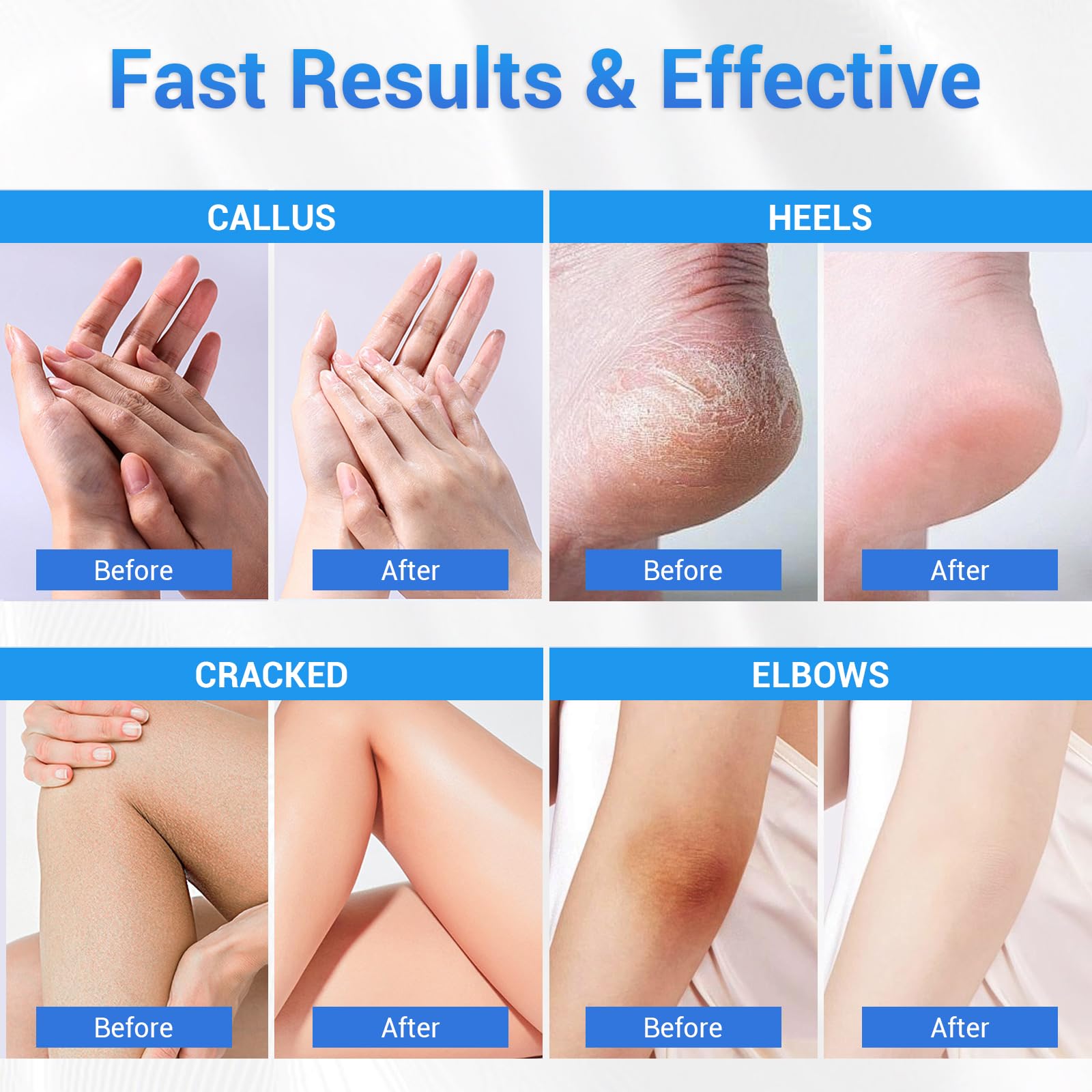 40% Urea Cream for Dry Cracked Heels - Maximum Strength Foot Moisturizer & Callus Remover - Deep Hydration for Feet, Hands, Knees & Elbows - Cracked Heel Repair Treatment - Perfect for Dry Skin Care & Pedicure Prep