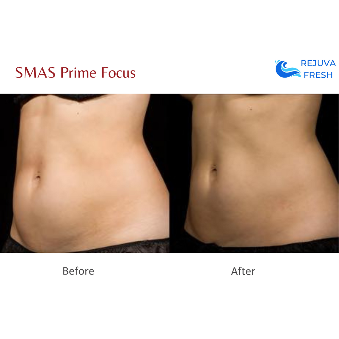 SMAS Prime Focus Professional HIFU Machine for Body & Face Lifting - Anti-Aging Skin Tightening & Wrinkle Reduction Device - At-Home Beauty Salon & Spa Treatment Equipment