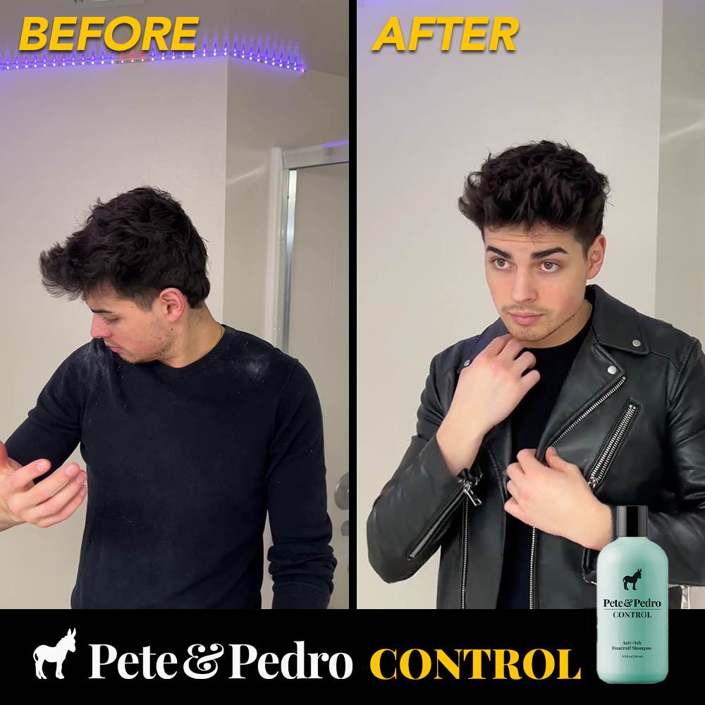 CONTROL Extra Strength Dandruff & Anti-Itch Shampoo for Scalp Relief - Soothes Flaky, Itchy Scalp - Ideal for Daily Use & Sensitive Skin