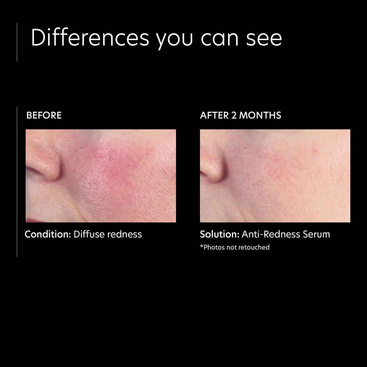 Best Anti Redness Serum for Sensitive Skin - Soothe & Calm Irritation - Perfect for Rosacea & Acne-Prone Skin - Daily Skincare Essential