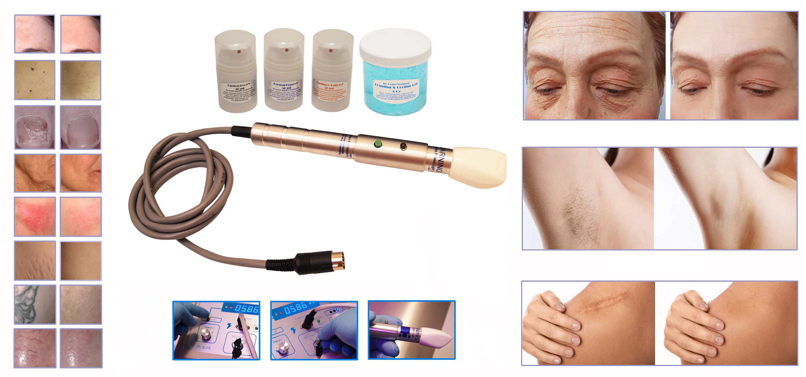 IPL750LS VSC Vascular Vein & Rosacea Treatment Machine - Professional Salon System for Skin Rejuvenation | Perfect for Facial Redness, Spider Veins & Rosacea Therapy