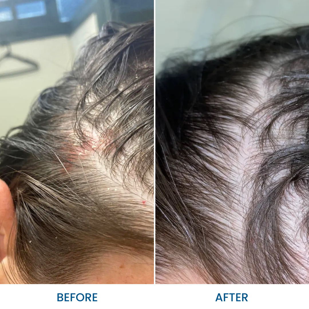 Best Scalp Relief Shampoo for Dry Itchy Scalp - Natural Dandruff Treatment & Hair Growth - For Men & Women - Daily Use at Home