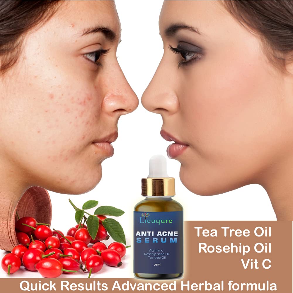 Licuqure Anti Acne Serum with Tea Tree Oil - Pimple & Blemish Treatment for Acne Scars & Dark Spots - Skin Soothing Collagen Serum for Clear, Healthy Complexion | Perfect for Daily Skincare Routine & Post-Breakout Recovery