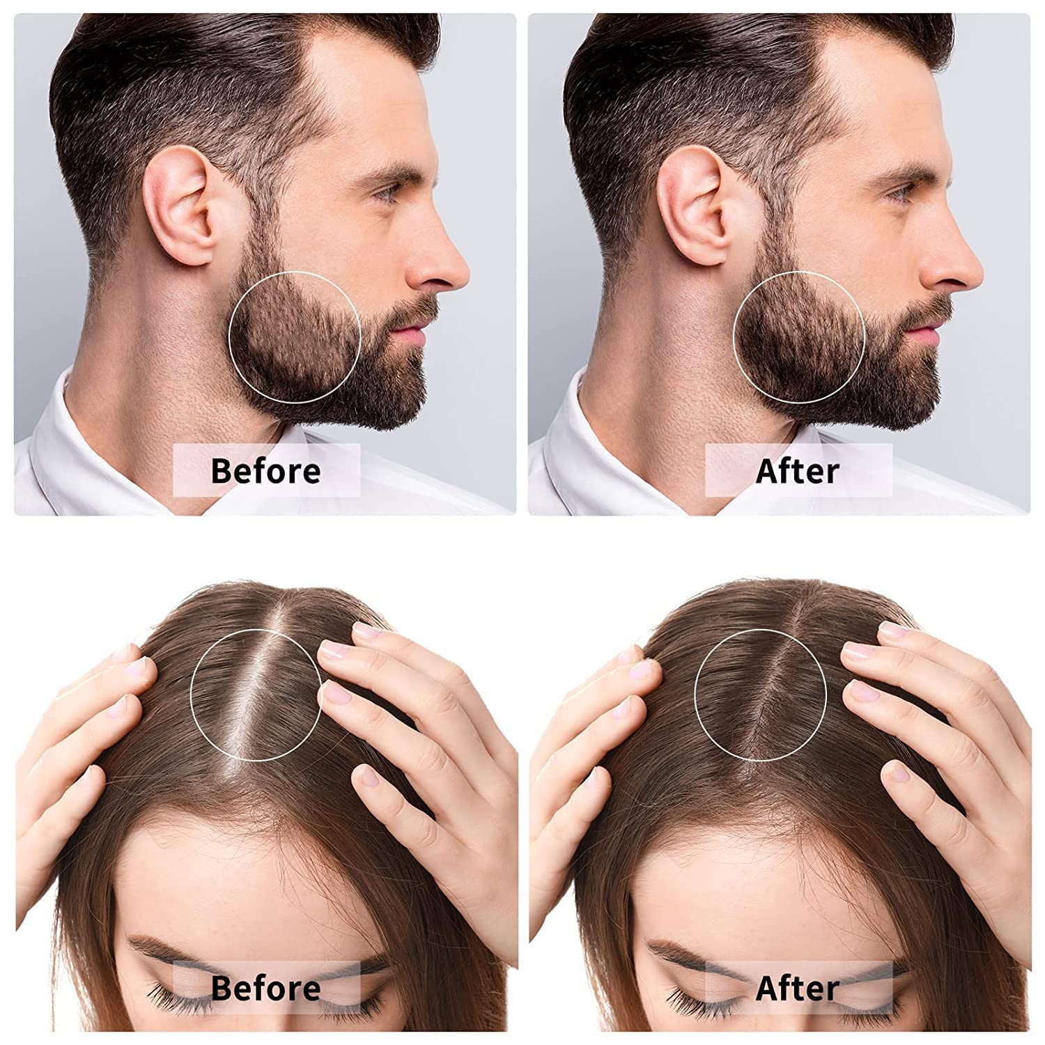 Derma Roller 540 Micro Needles 0.5mm Titanium Alloy for Hair Growth & Beard Regrowth - Reduce Hair Loss & Stimulate Follicles - Safe Effective Skin Care Tool for Men & Women - Perfect for Home Hair Treatment & Facial Rejuvenation