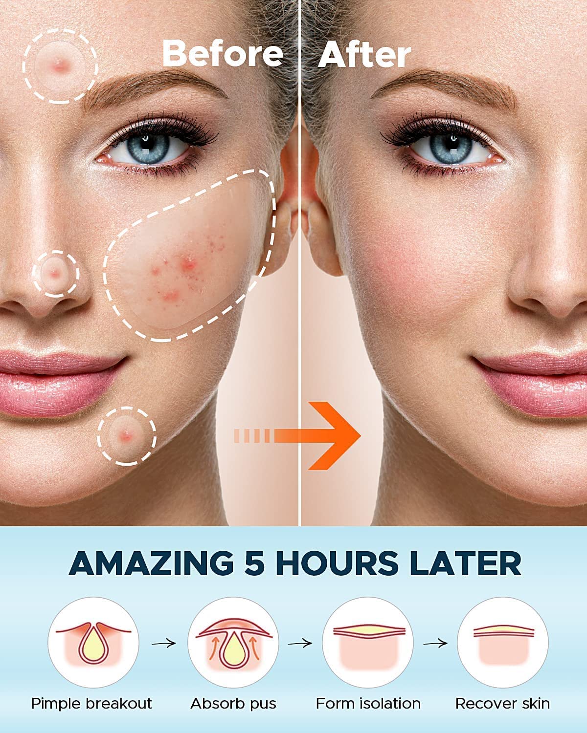 72 Pcs Hydrocolloid Acne Pimple Patches for Face - Effective Spot Treatment to Calm & Relieve Breakouts - Clear Skin Facial Care - Perfect for Overnight Use & Daily Acne Treatment
