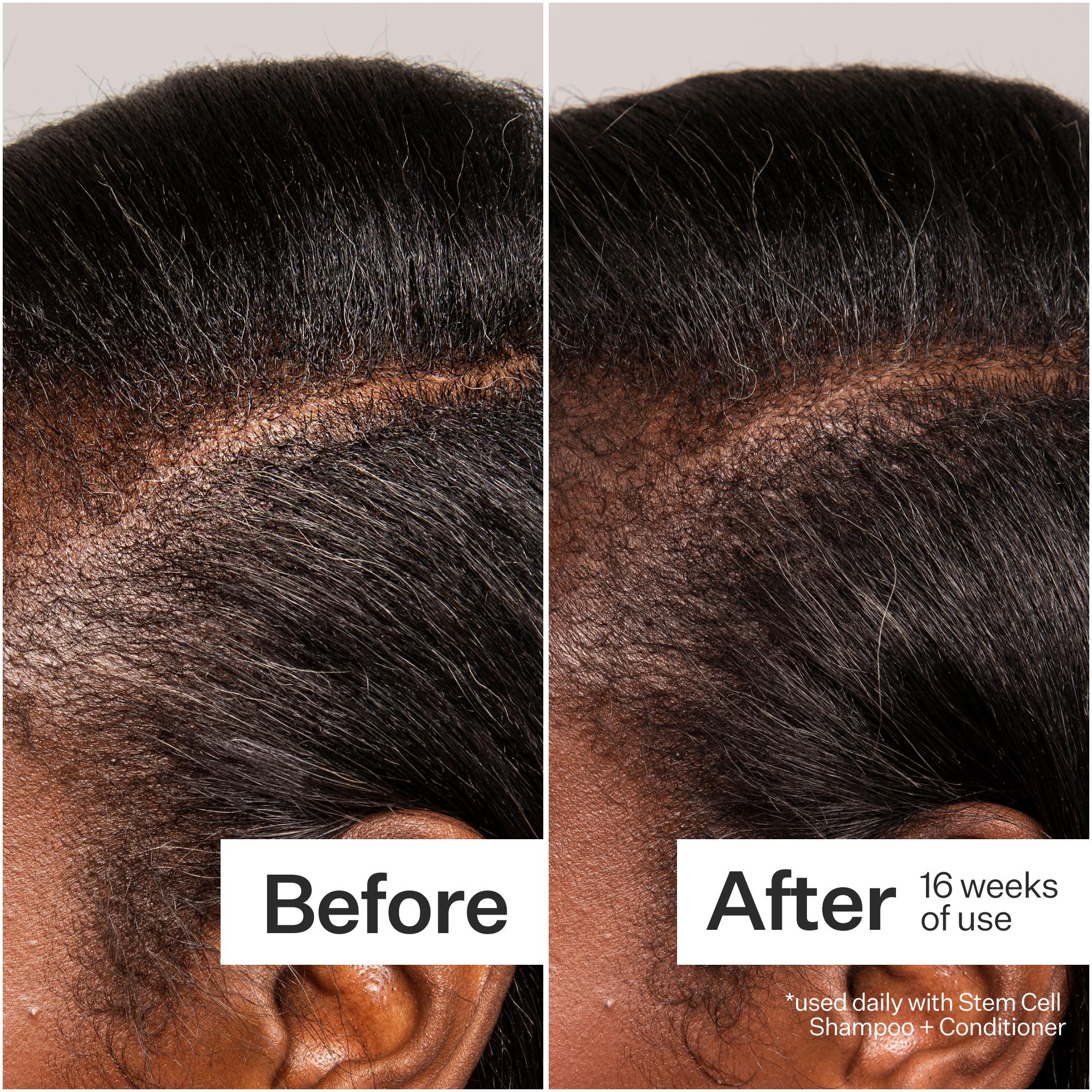 Act+Acre 3% Stem Cell Peptide Hair Treatment for Thinning Hair - Stimulates Hair Growth & Reduces Breakage - Perfect for Daily Scalp Care & Hair Regrowth Routine