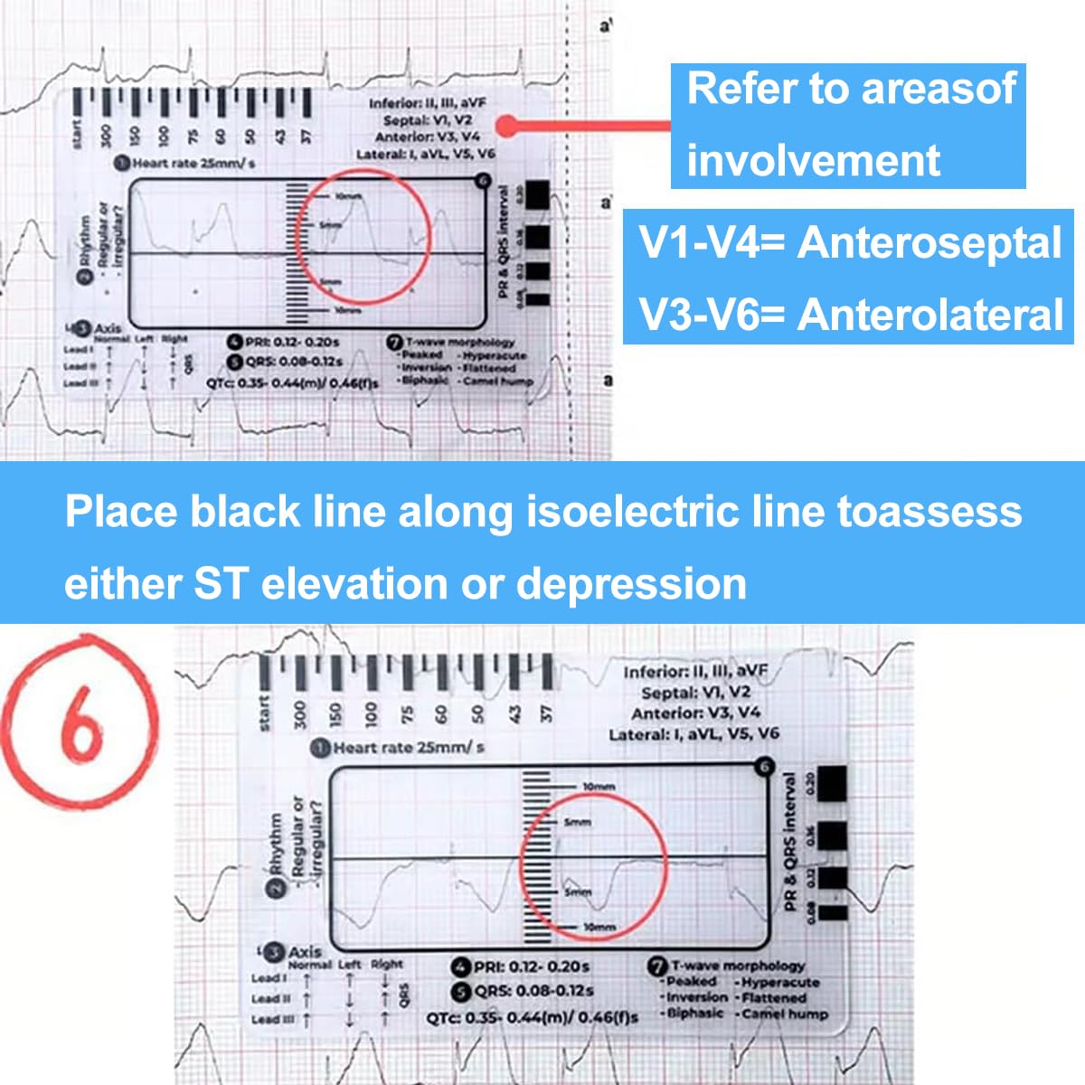 7-Step ECG Ruler for EKG Interpretation - Transparent Caliper Measuring Tool with Portable Assessment Card (2PCS) - Perfect for Medical Students, Nurses & Doctors for Heart Rate Monitoring & ECG Analysis