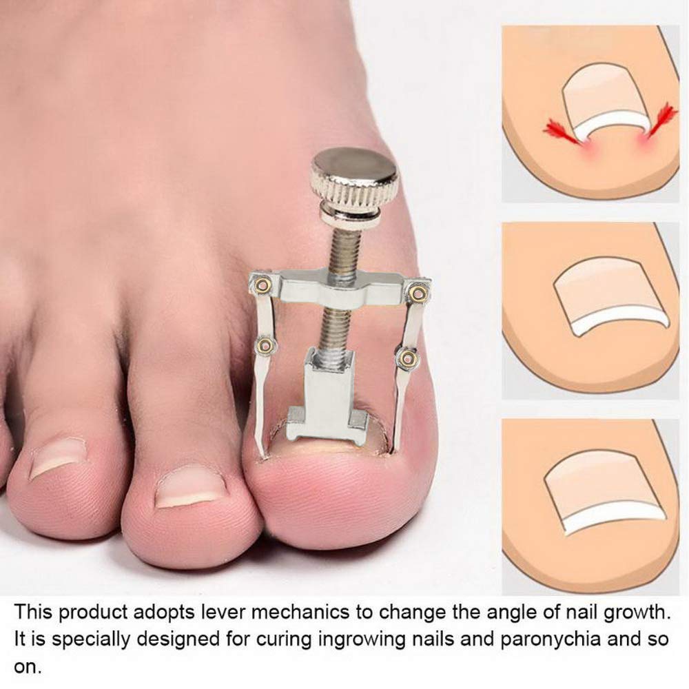 EXCLUZO Nail Correction Kit - Toenail & Fingernail Straightening Treatment with Stickers, Clamp & Lifter - Fix Ingrown, Curved Nails for Healthy Feet & Hands - Perfect for Pedicures, Manicures & Daily Nail Care
