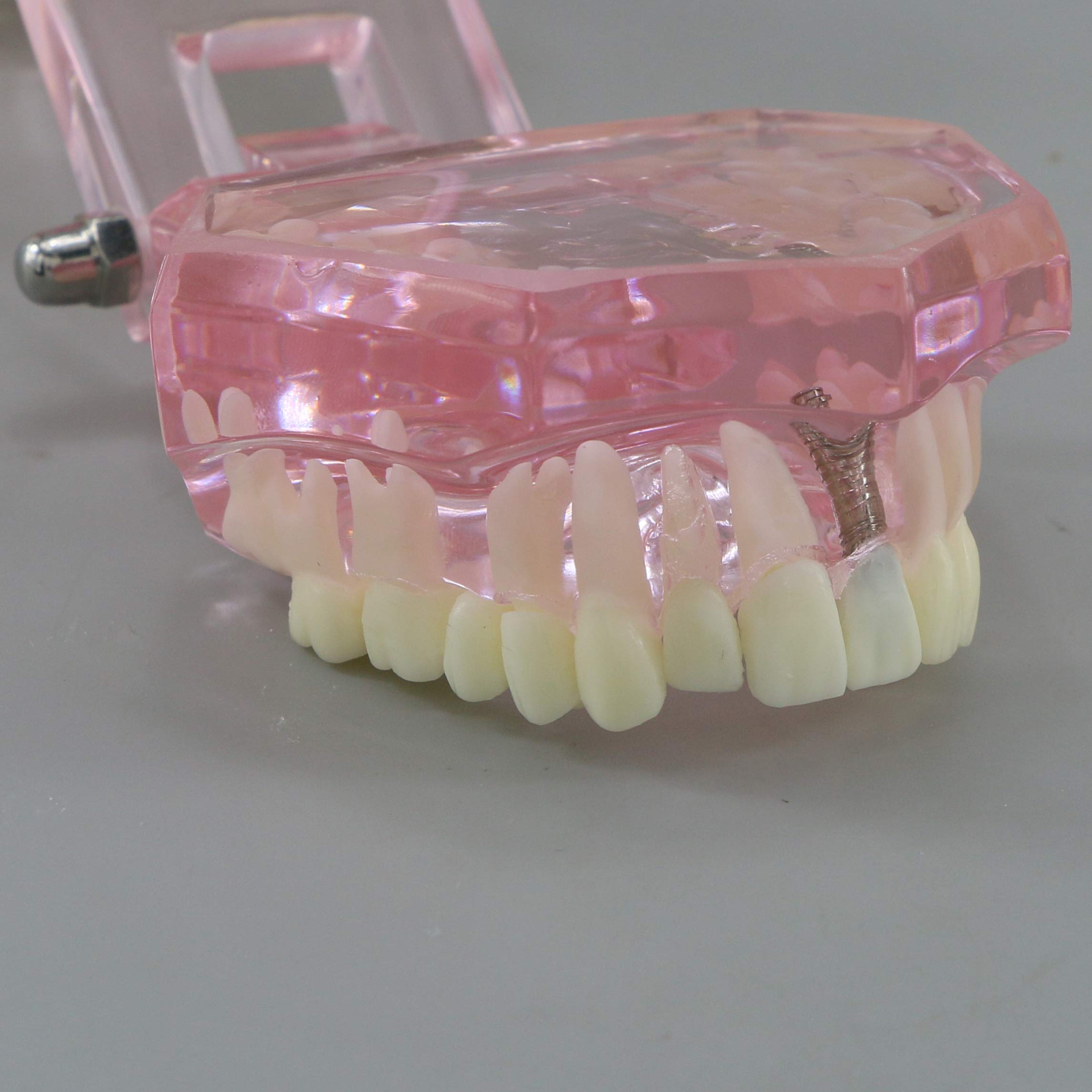 Dental Teeth Model - Implant Restoration Bridge Typodont for Dental Teaching & Study - Oral Pathology Demonstration (M2001 Pink) - Perfect for Dental Schools, Clinics & Training Labs