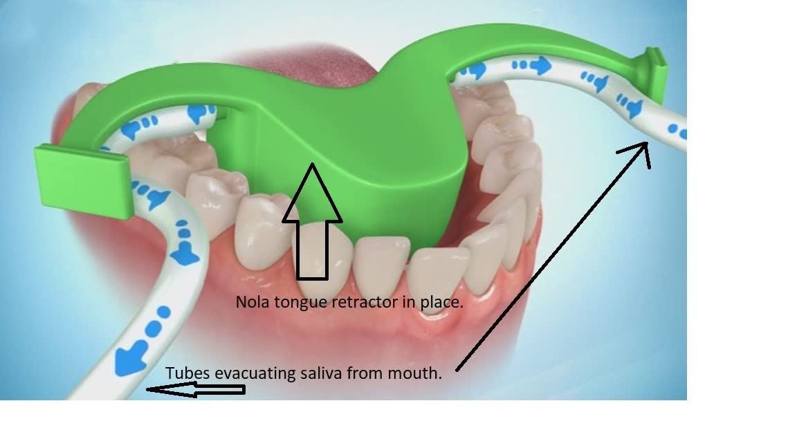 **Nola Retractor Dental Oral Dry Field System - Autoclavable & Disposable Cheek Retractor for Teeth Whitening & Orthodontic Procedures | Ideal for Dentists, Hygienists & Mouthguard Fitting**    *(Use Case: Perfect for dental clinics, orthodontic treatments, teeth whitening sessions, and mouthguard fittings to ensure a dry, clear working area.)*