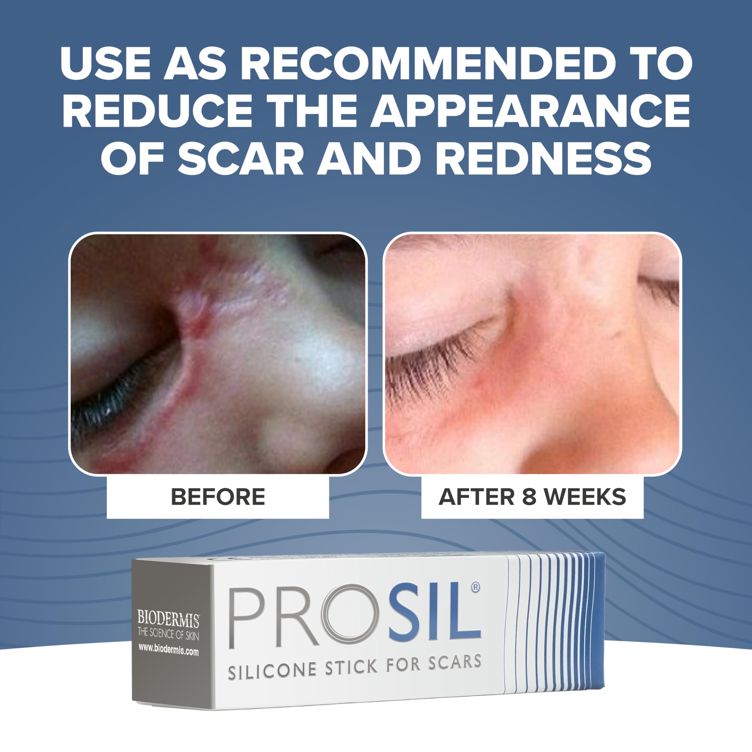 ProSIL Silicone Scar Stick - Effective Scar Treatment Gel for Surgical Scars, Acne, Burns & C-Sections | Safe for Kids, Men & Women | Medical-Grade Silicone Scar Therapy (17g) | Perfect for Post-Surgery Recovery & Daily Skin Care
