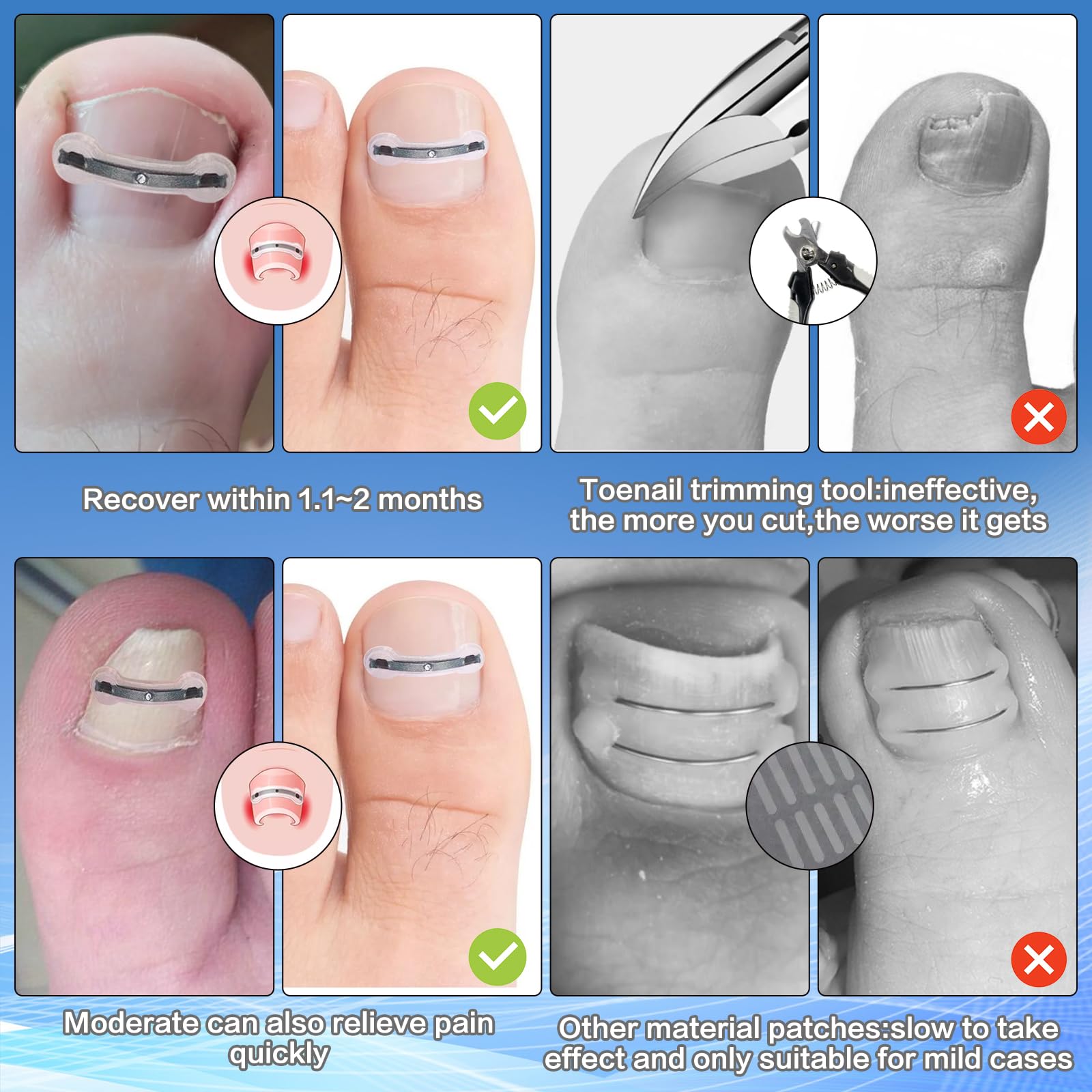 Professional Ingrown Toenail Removal Kit - Titanium Alloy Toenail Corrector Tool for Pain Relief & Home Treatment (0.75-0.82 Inch) - Perfect for Athletes, Runners & Daily Foot Care