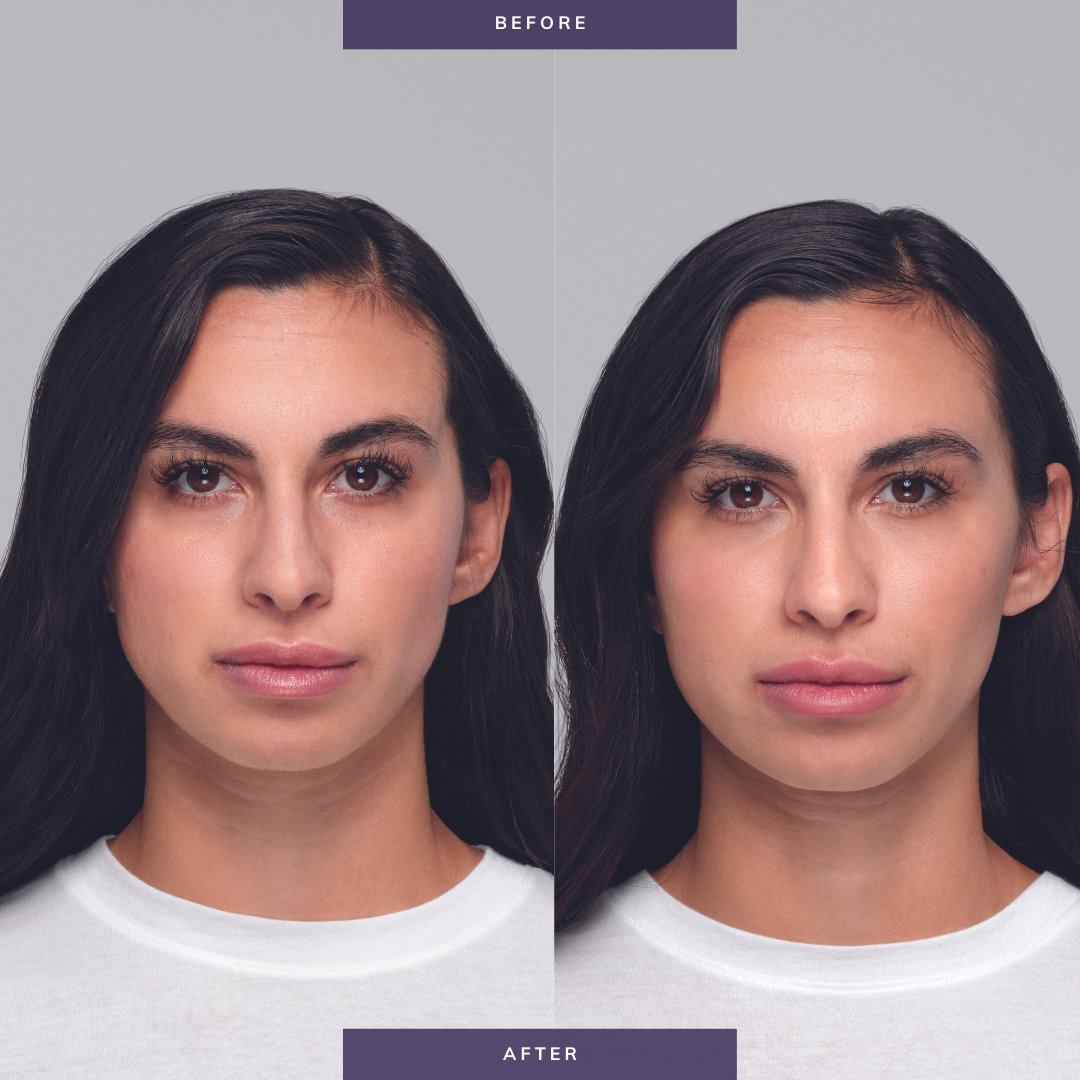 Restylane® Lyft Dermal Filler for Cheek Augmentation & Facial Volume - FDA Approved Hyaluronic Acid Injections for Wrinkles & Contouring - Professional Cosmetic Treatment for a Youthful Look