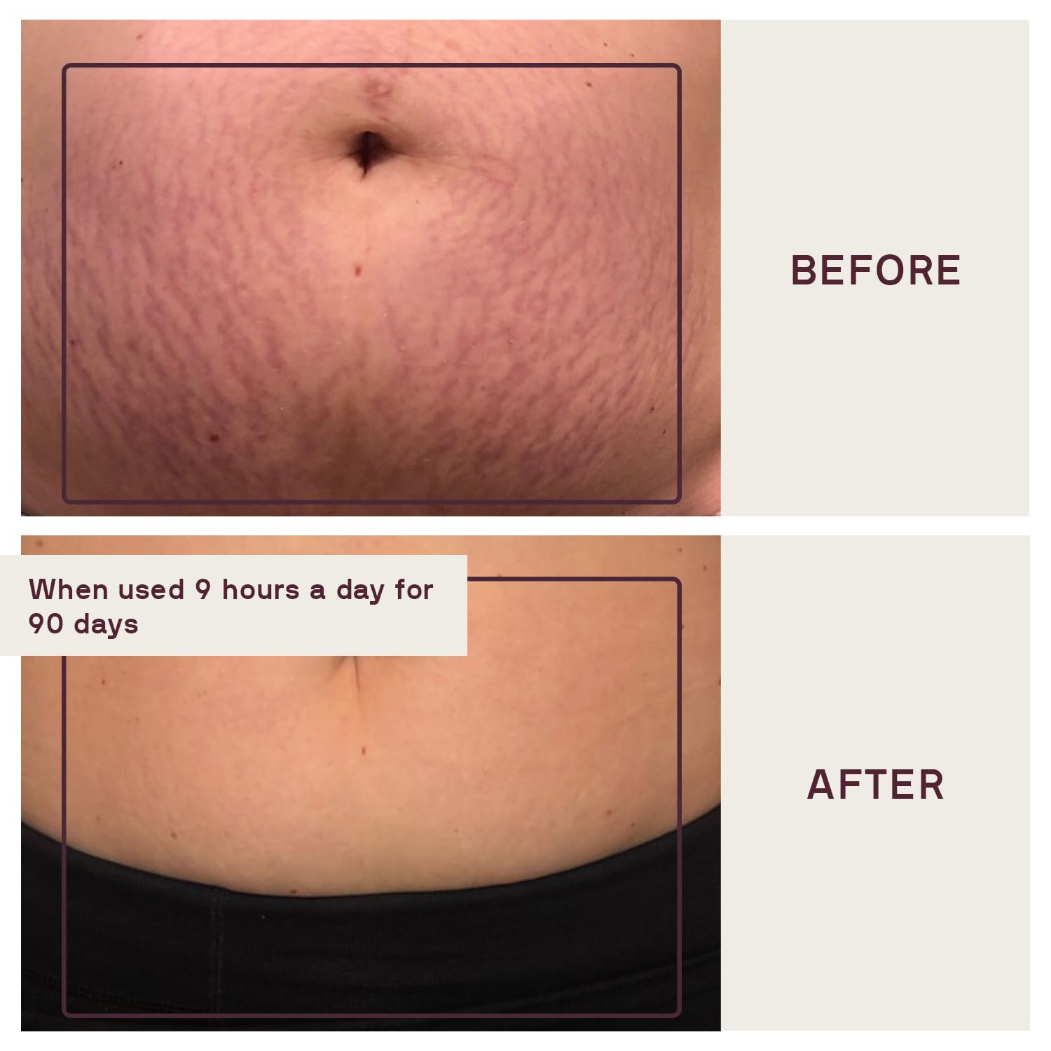 Dermaclara Large Body Patch for Pregnancy Stretch Marks - Silicone Gel Sheets for C-Section Scar Cover & Belly Scar Removal, Reusable Maternity Skincare (2 Patches + Cleanser) - Perfect for Postpartum Recovery & Smooth Skin Care