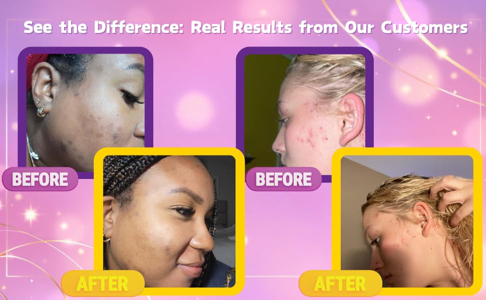 Best Acne Serum for Clear Skin - Fights Breakouts, Reduces Scars & Controls Oil | Detoxifying & Nourishing Face Treatment with Collagen Boost | Perfect for Daily Skincare Routine & Post-Acne Care | I Am Melanin Magic
