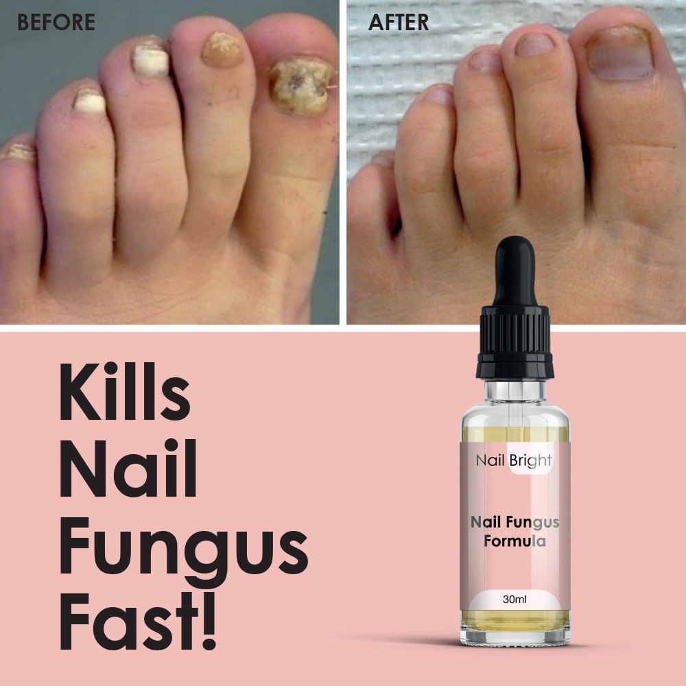 Nail Bright Serum - Maximum Strength Anti-Fungal Treatment to Prevent Infection | For Healthy & Shiny Nails at Home or Salon